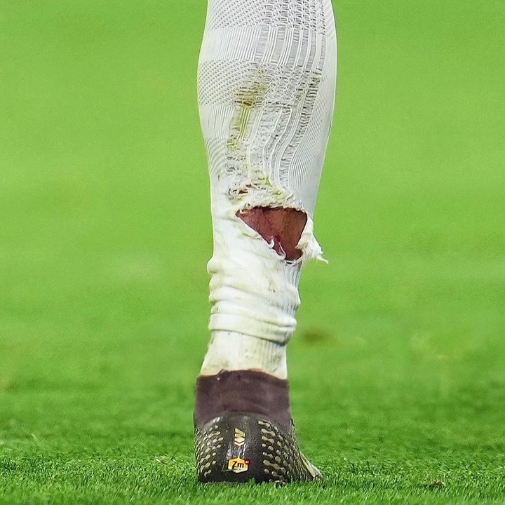 开云体育app下载-有点狠！塔蹬踏姆巴佩小腿染黄，姆巴佩小腿袜被踩破露出血痕